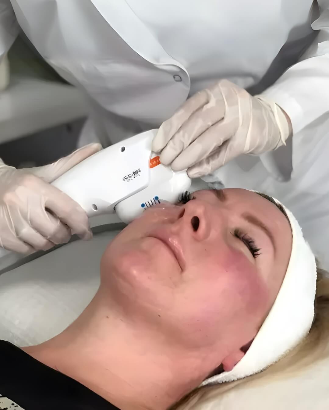 HIFU Facial Wrinkle Removal System - Treatment in Action