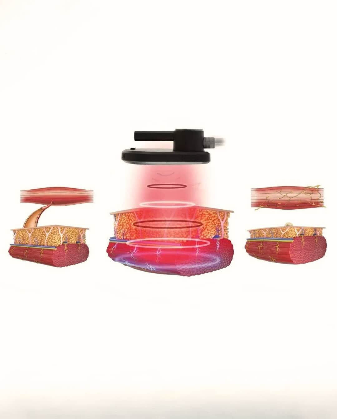 Magnetic Muscle Device  - Muscle Stimulation Diagram