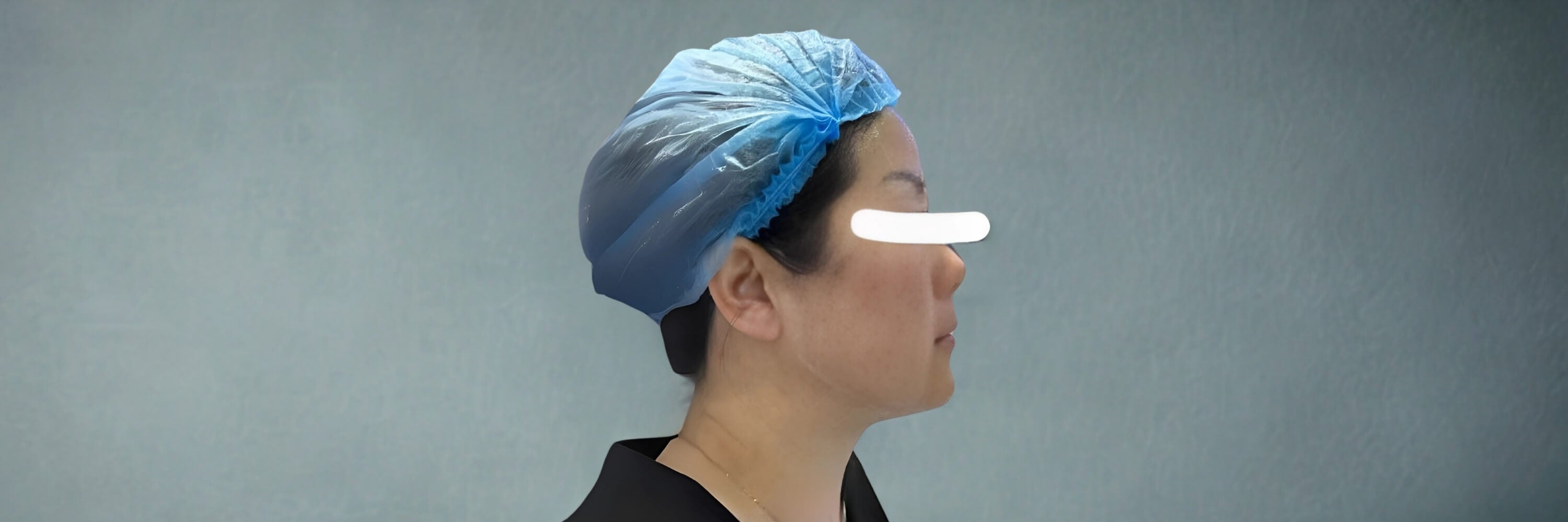 After HIFU facial treatment with visibly lifted, smoother, and more defined jawline.
