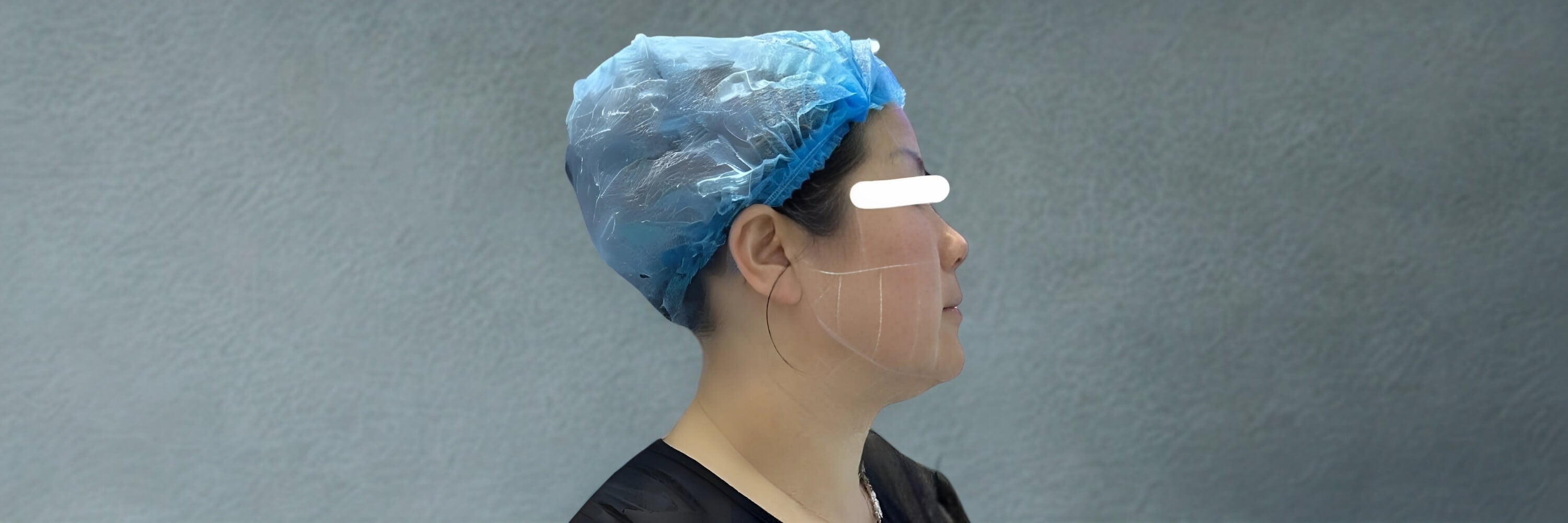 Before HIFU facial treatment showing sagging skin and jawline laxity.