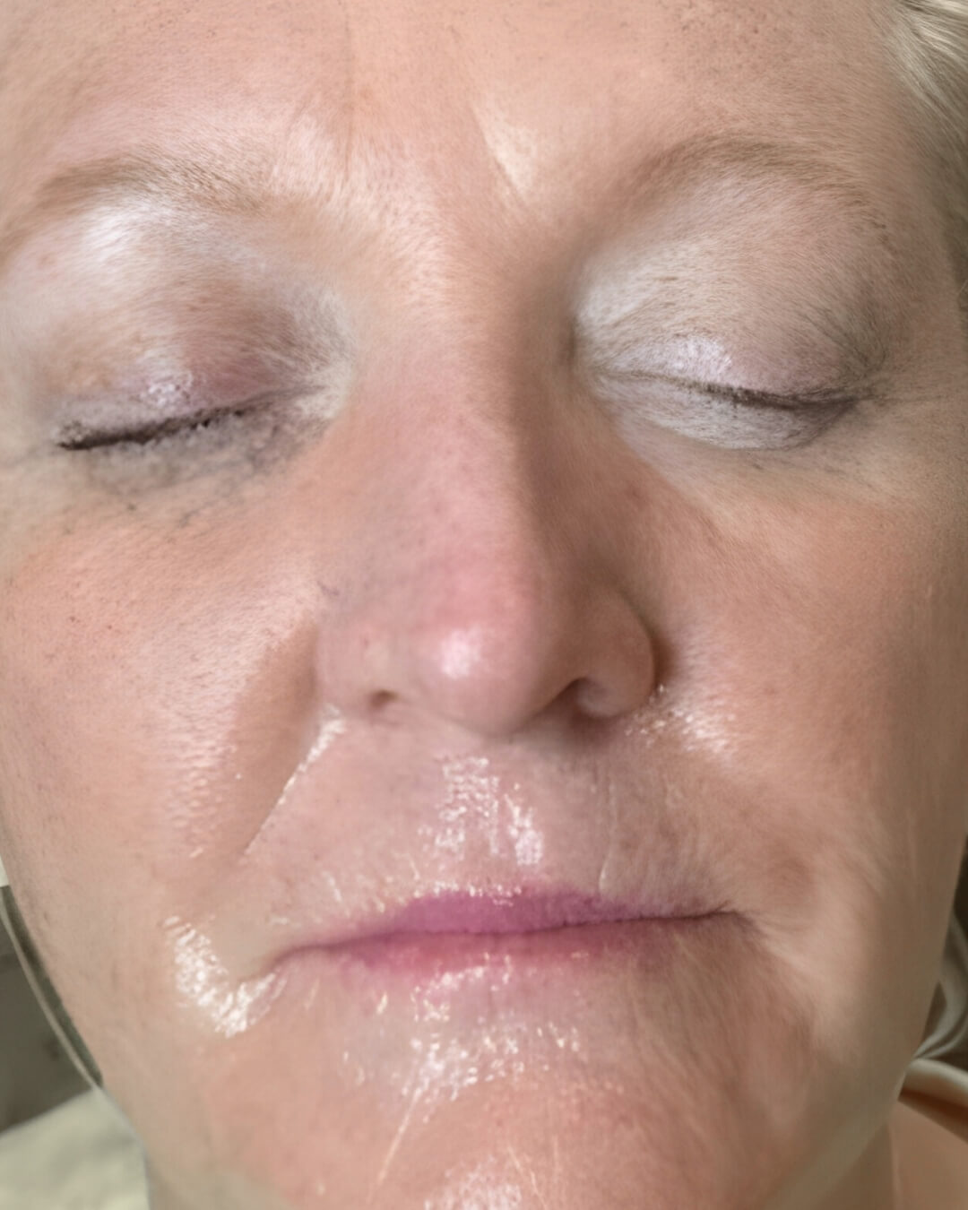 After — mature female face close-up after HIFU; smoother perioral area and jawline, reduced fine lines, eyes closed.